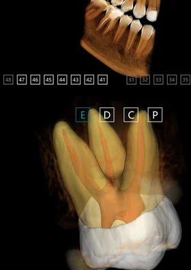 Meyer 3D Pro, Endodonti