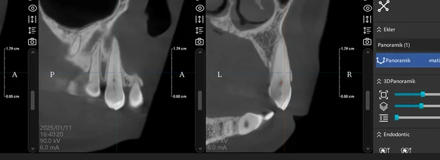 Meyer 3D Pro, İmplant planlaması